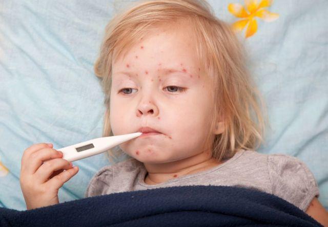 家中有麻疹患儿 该怎么护理？