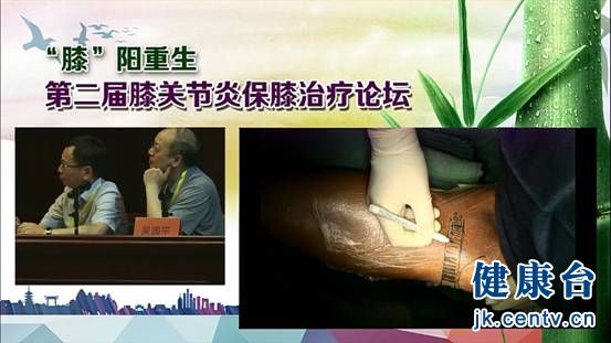 第二届保膝关节治疗论坛在京举办