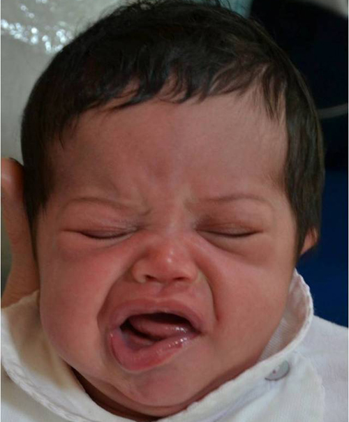 新生儿哭相难看不对称 是病理性的吗？