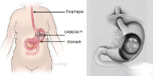 FDA批准第2款胃内球囊减肥设备