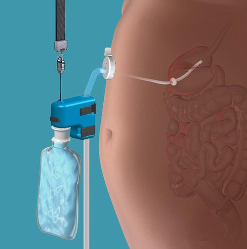 FDA批准第2款胃内球囊减肥设备