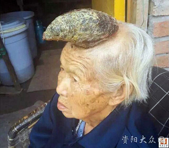 87岁老妇头上黑痣长成"独角"