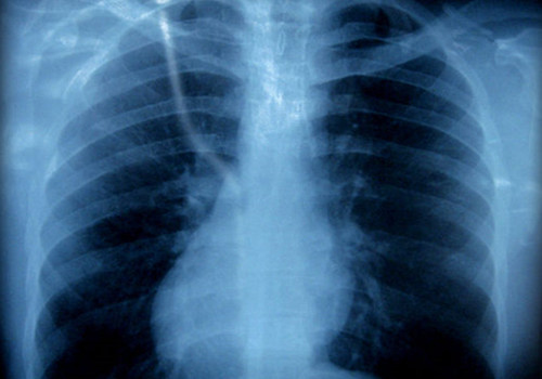 靠胸片发现肺癌不靠谱