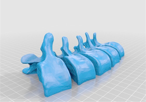 3D打印技术还原患者腰椎