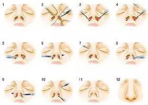 鼻头缩小与鼻翼缩小的区别在哪?