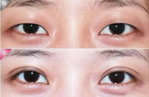 双眼皮术后，医生为什么会让你努力睁大眼睛呢？