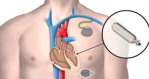 心脏起搏器即将脱离电池 驱动它的动力将来源于心脏本身