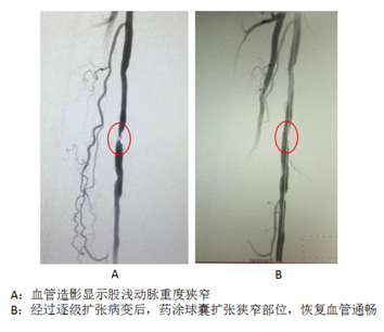 清华长庚医院血管外科率先应用"药涂球囊"治疗下肢缺血