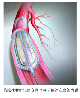 清华长庚医院血管外科率先应用"药涂球囊"治疗下肢缺血