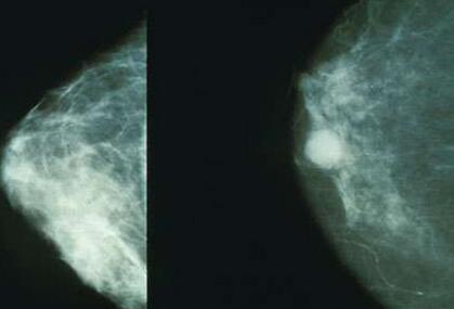 AEM：有益菌帮助女性免受乳腺癌侵袭