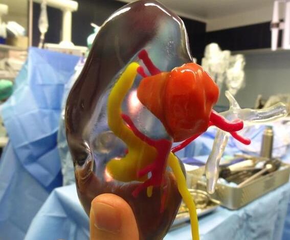 3D打印技术帮助医生完成精密的肾脏肿瘤移除外科手术