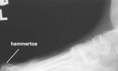 Additive Orthopaedics开发3D打印植入物治疗槌状趾