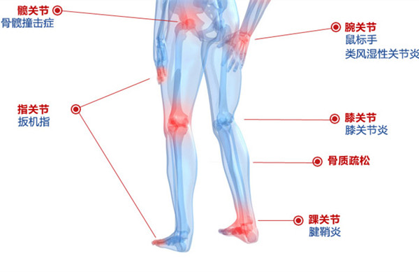 关节炎向年轻人延伸 “偏爱”久坐人群