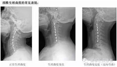 清华长庚康复医学科：请收回你前探的头