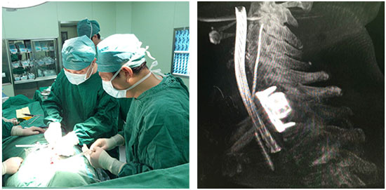 清华长庚使用3D打印技术实施高难度脊柱肿瘤手术