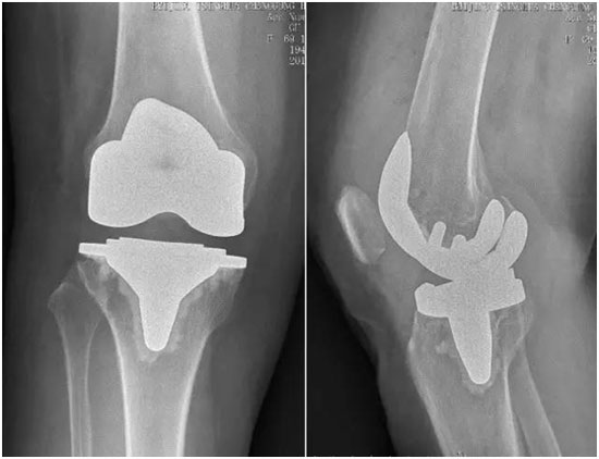 增效膝关节置换术清华长庚骨科采用最新关节假体