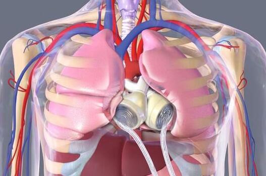 不再等待移植：永久性全人造心脏即将“服役”