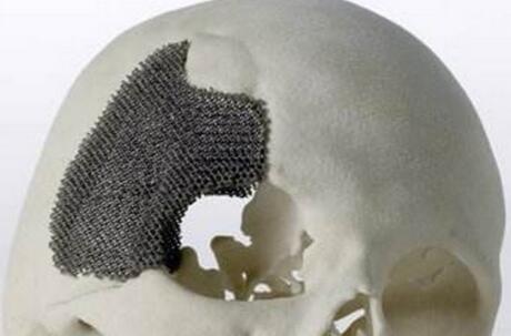 颅颌面硬组织植入用3D打印钛合金材料的研究进展