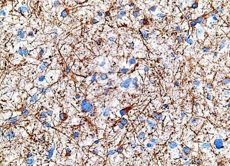 科学家找到控制脑瘤生长的关键基因