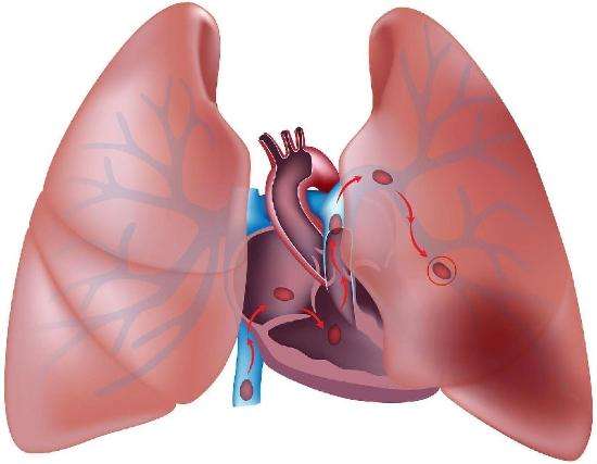 慢阻肺是肺功能的慢性“杀手” 