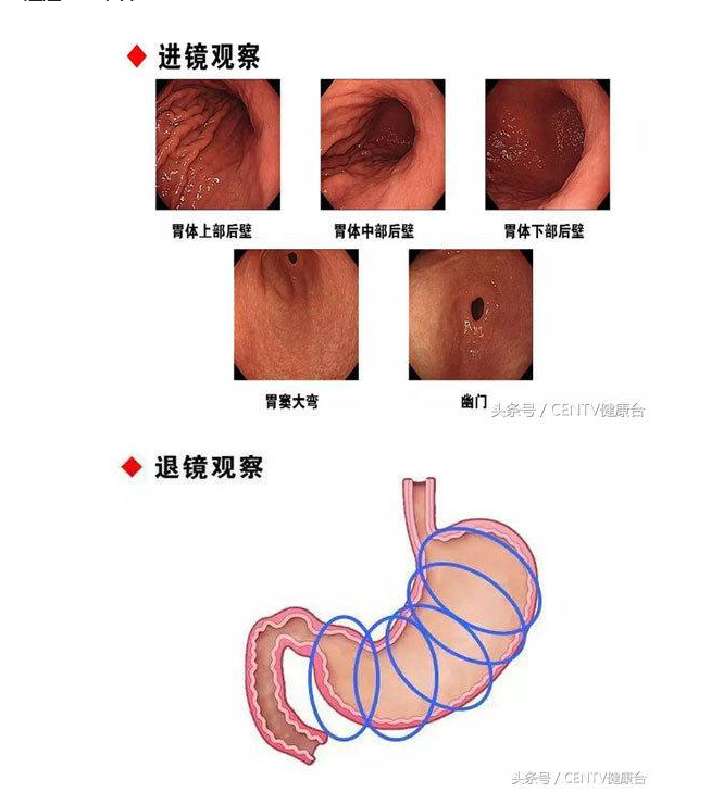 请花几分钟看完：对于发病总数占全球一半的胃癌 你有什么看法？