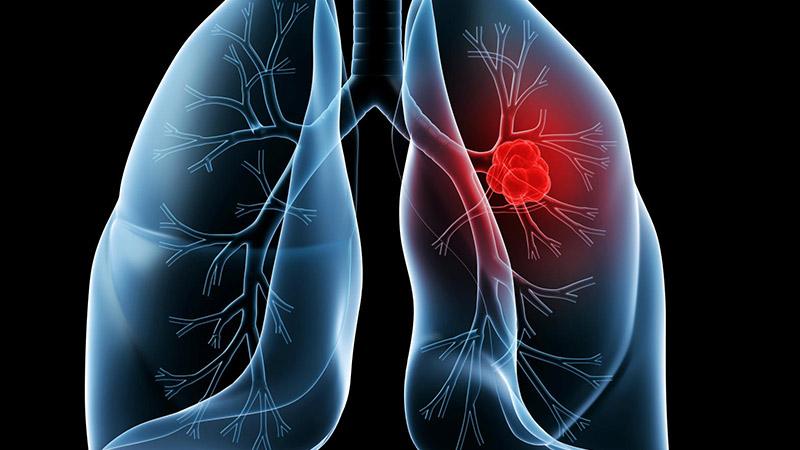 肺癌是被“气”出来的病 女性防肺癌先防“三霾”