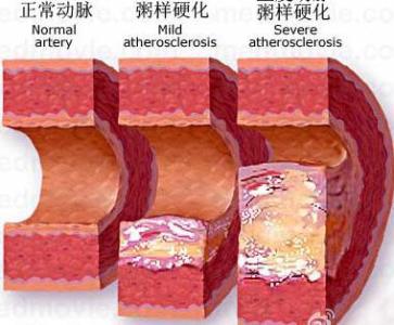 动脉粥样硬化斑块有逆转可能