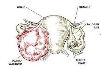 七成卵巢癌发现已属晚期
