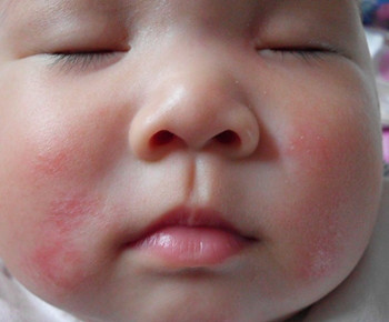 研究开发低副作用湿疹疗法