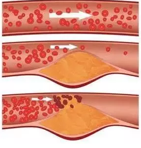 血管堵有很多征兆